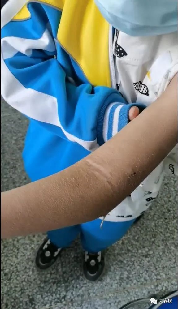 孩子胳膊摔伤肿了不能弯曲一直疼,9岁男孩摔倒手臂痛怎么办