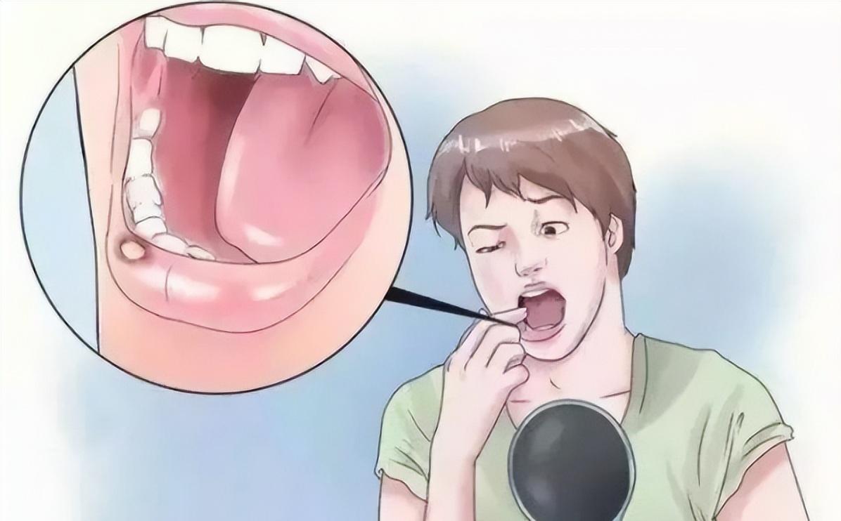 怎么确定口腔处有尖锐性湿疣,怎么判断是不是口腔尖锐性湿疣