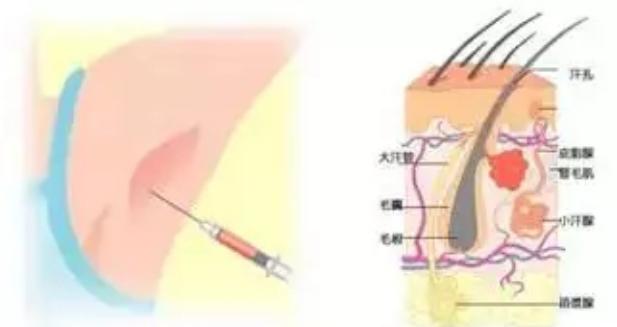 祛除狐臭腋臭,祛除腋臭