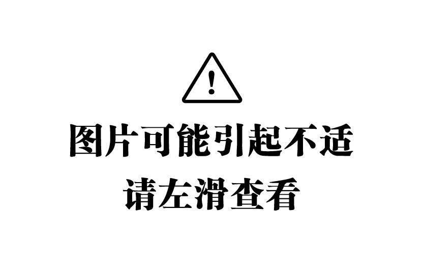 身上5种疣跟HPV感染有关，一个习惯加速它的传播