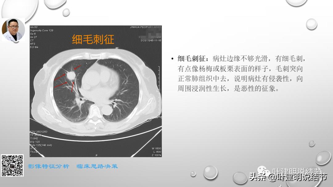 在《一脉阳光》呼吸影像诊断专题培训班上的讲课PPT（第一部分）