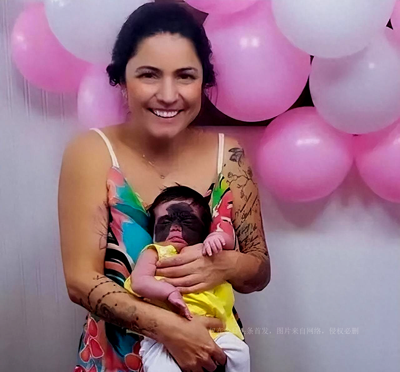 还记得天生胎记酷似“蝙蝠侠”的女婴吗？6次整容后，仍需治疗