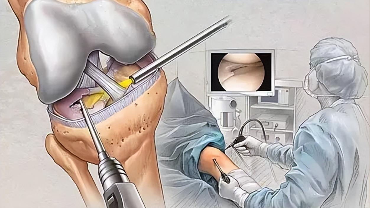 滑膜炎怎么恢复注意什么,滑膜炎怎样治疗才能快速恢复