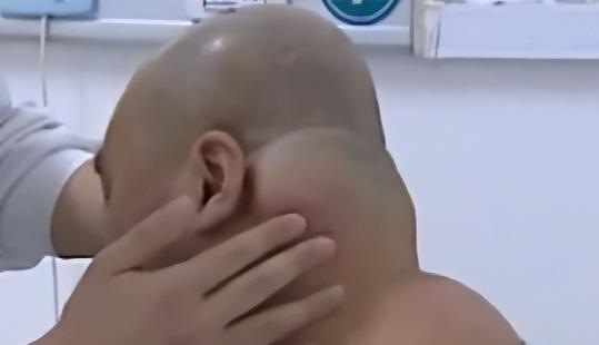 62岁大叔喝出河马脖,辽宁男子喝酒成河马