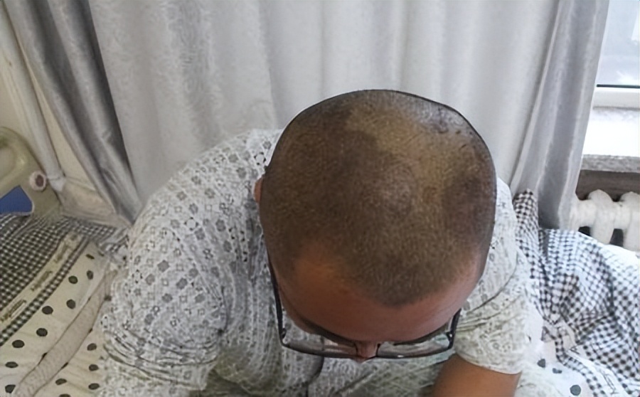 头皮经常起疙瘩有脓包是什么原因,头皮总是长疙瘩或脓包是什么原因