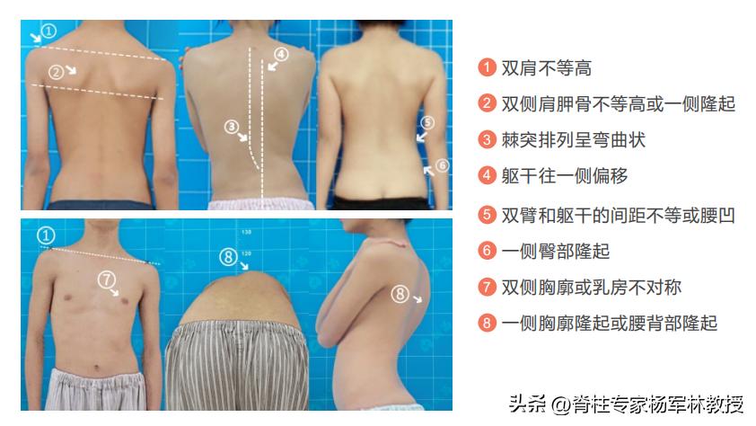 脊柱侧弯10度会出现剃刀背吗,剃刀背会误诊吗