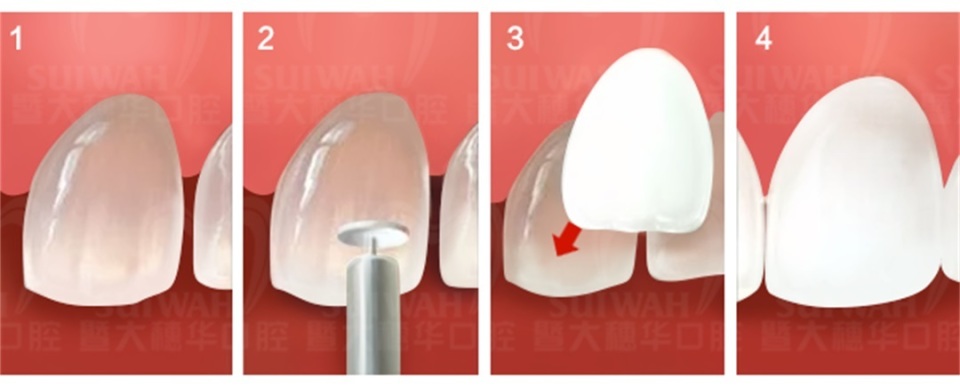 中山大学附属口腔医院牙缝修复,苏州华夏口腔修复牙缝