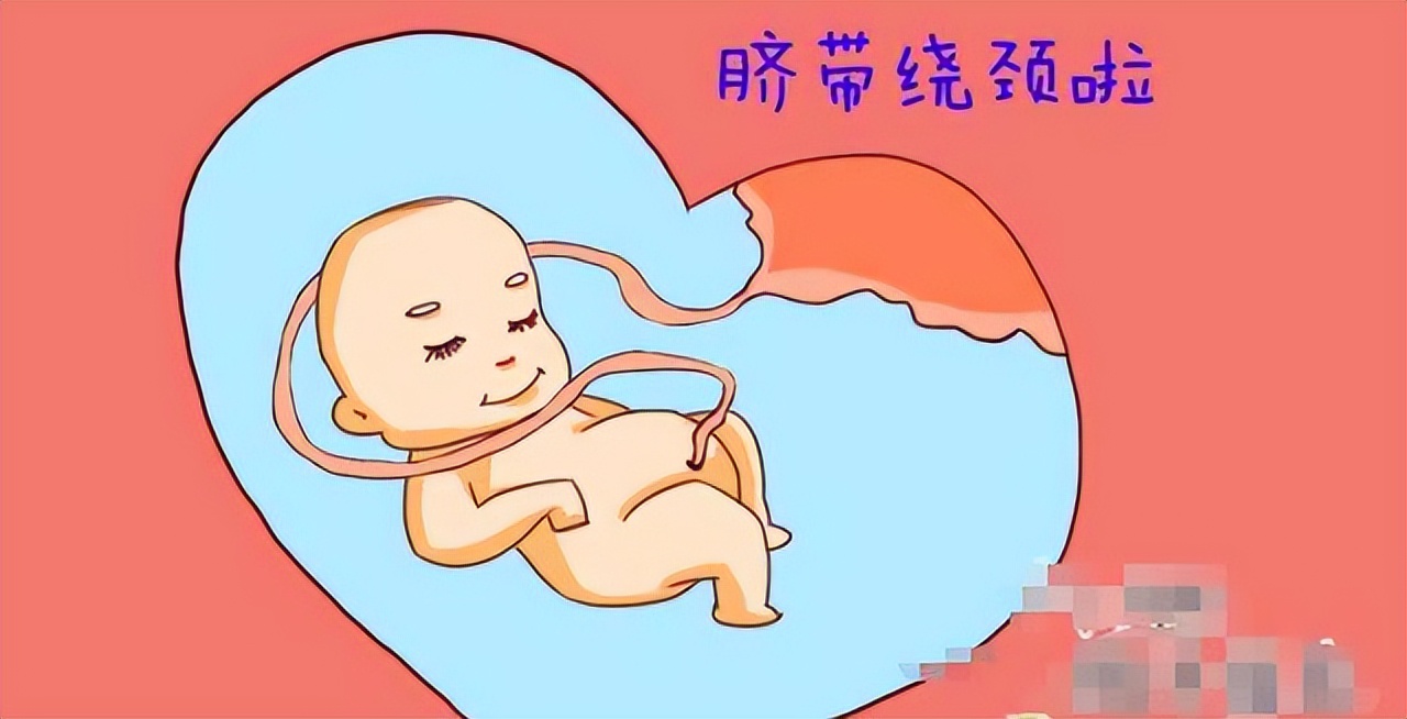 胎儿脐带绕颈孕妈妈心慌,胎儿脐带绕颈缺氧妈妈有什么感觉
