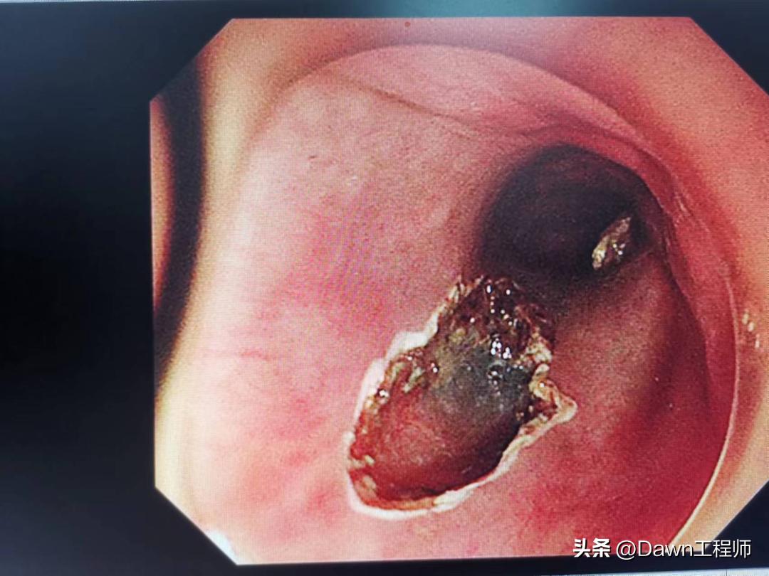 丰县人民医院胃切除手术,食管下段切除肿物手术