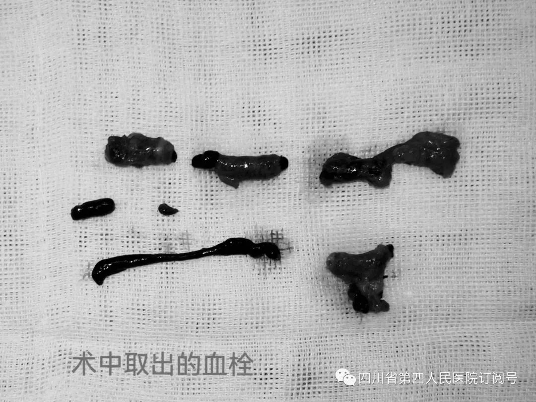 胳膊被锯断手术接上后多久恢复,肘部神经断裂恢复的案例