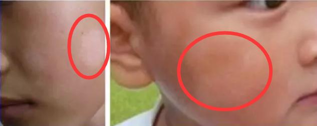 小孩子脸上长白斑需要吃打虫药吗,孩子脸上长斑是该打虫子了吗