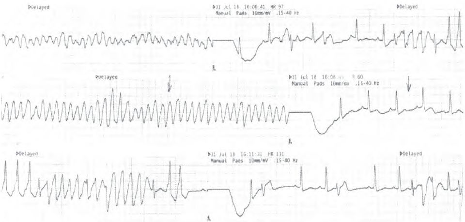 室性心动过速的五步鉴别方法,室性心动过速的诊断标准