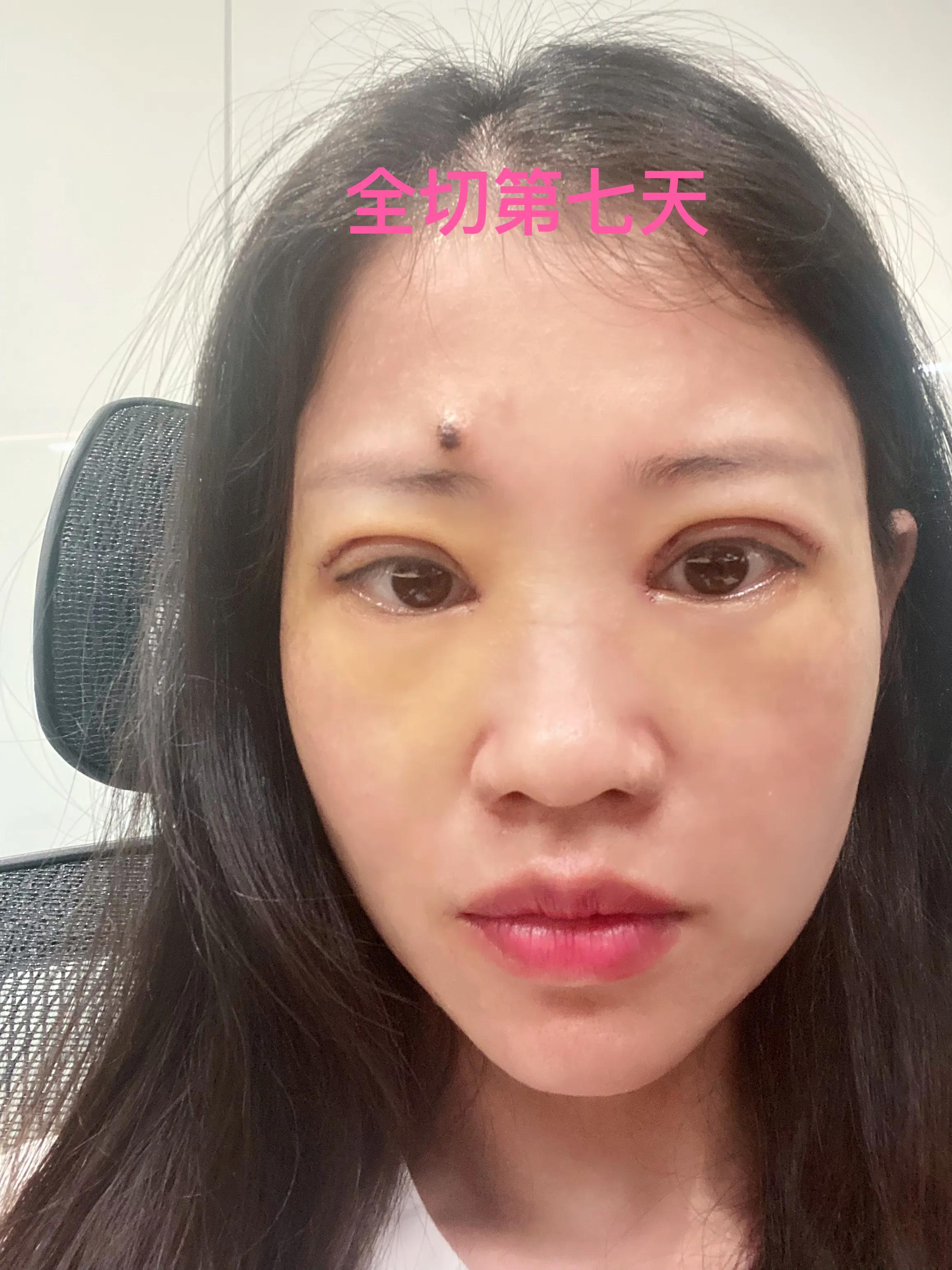 做双眼皮恢复期间能吃红糖吗,恢复最快的双眼皮