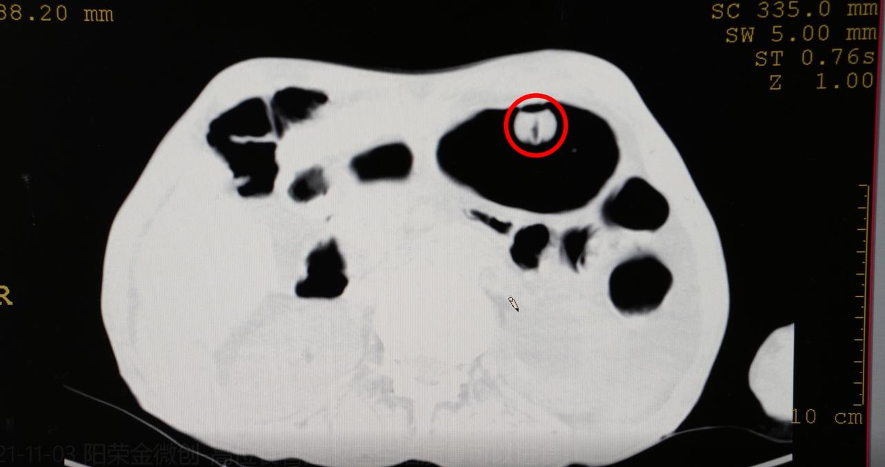 食管癌导致气管瘘,食管癌纵隔瘘能长好吗