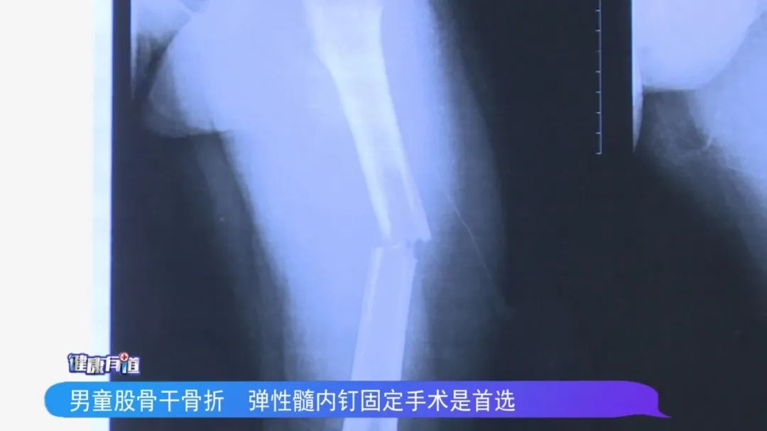 儿童股骨干骨折弹性髓内钉内固定,儿童股骨骨折打髓内钉