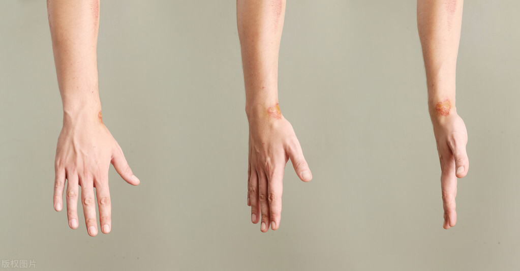 脚上破了很大一块皮怎么消炎,脚上破了很大一块皮怎么办