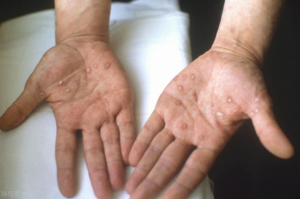 这4种性病，即使戴了“套套”也防不住！有对象的千万注意！