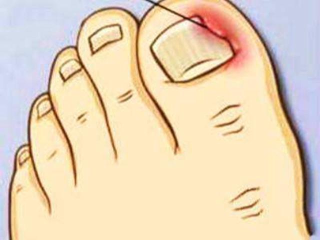 脚趾甲总往肉里扎该怎么办,脚趾甲往肉里长又疼又痒教你一招