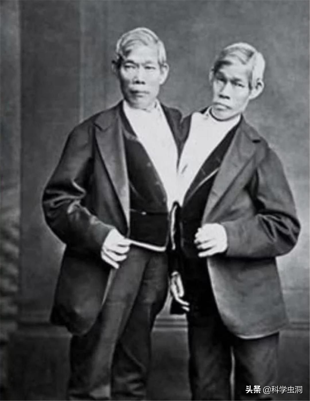 连体姐妹其中一个人死了怎么办,连体姐妹一个死了另一个咋办