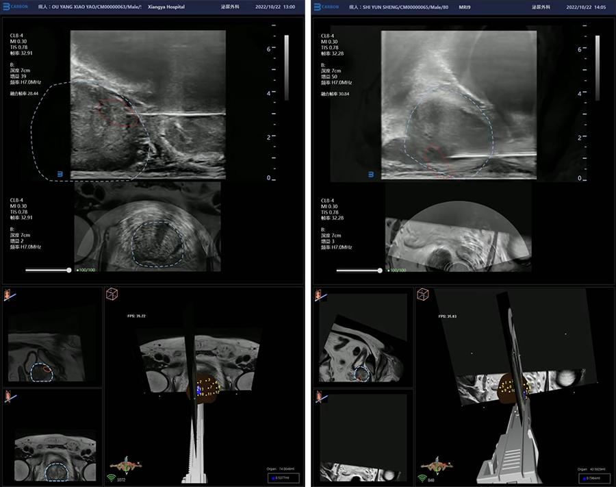 湖南湘雅医院祖雄兵预约,长沙湘雅附一医院祖雄兵