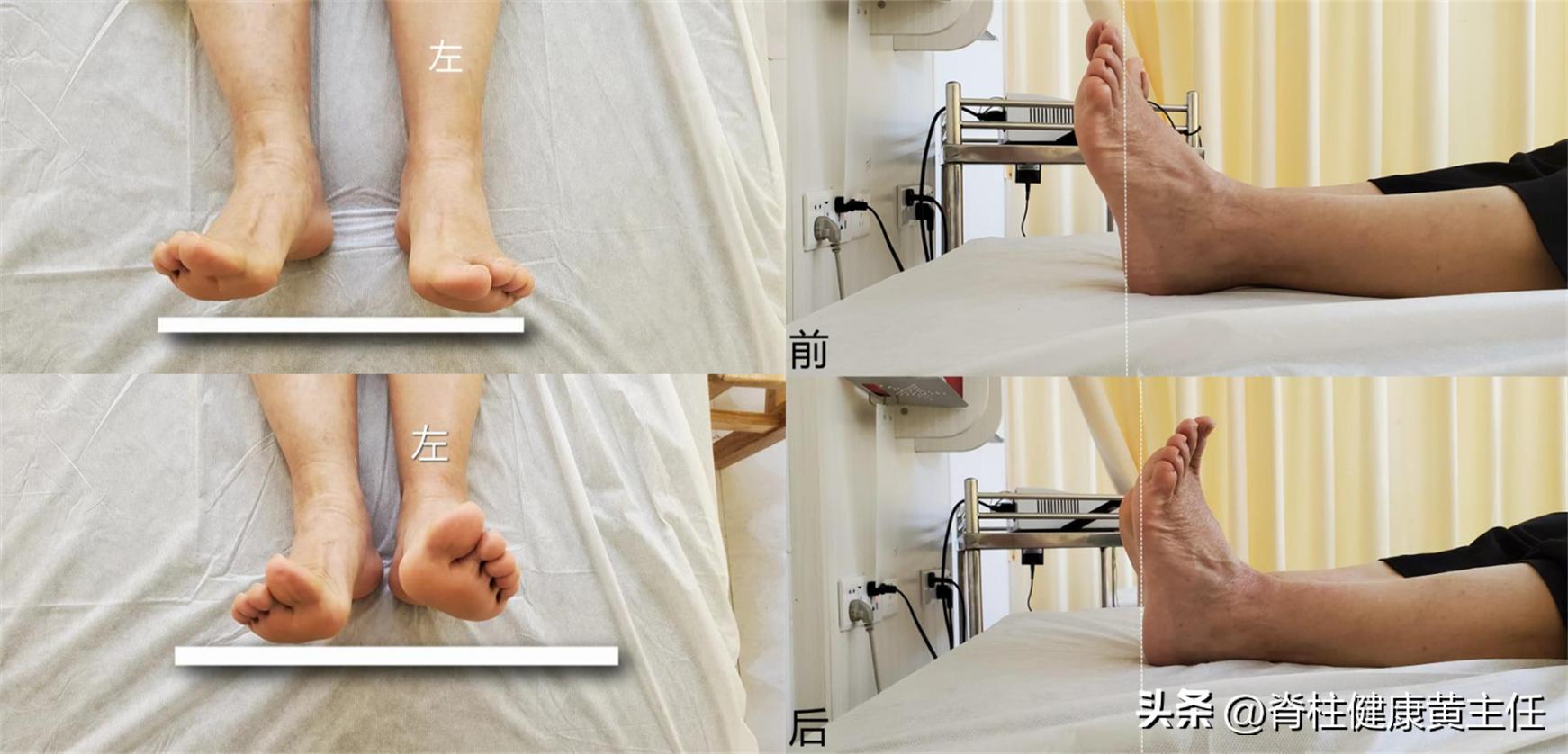 足底第二脚趾神经走路痛什么原因,足底筋膜炎疼的无法走路怎么缓解