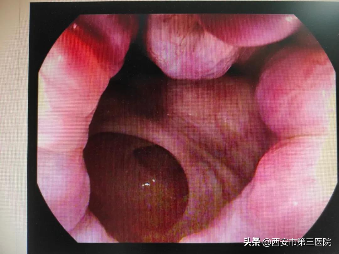 内痔出血多会导致贫血吗,内痔出血伴有贫血怎么办