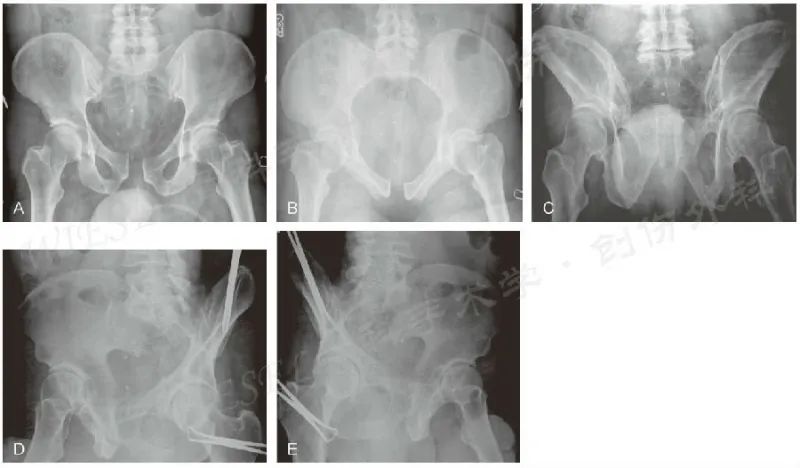 耻骨联合分离和盆骨有区别吗,怀孕耻骨联合分离是怎么回事