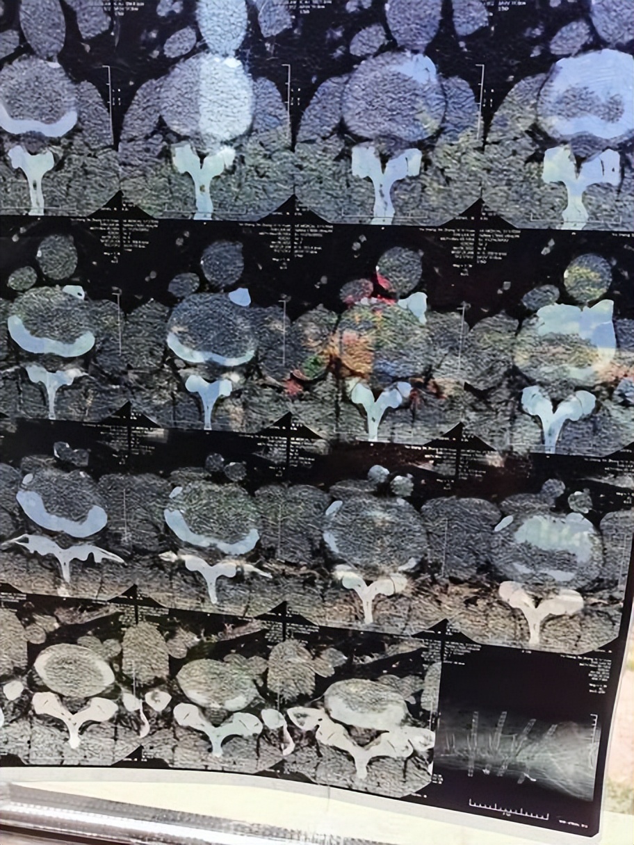 早期的腰突患者，不用焦虑，早发现早治愈！