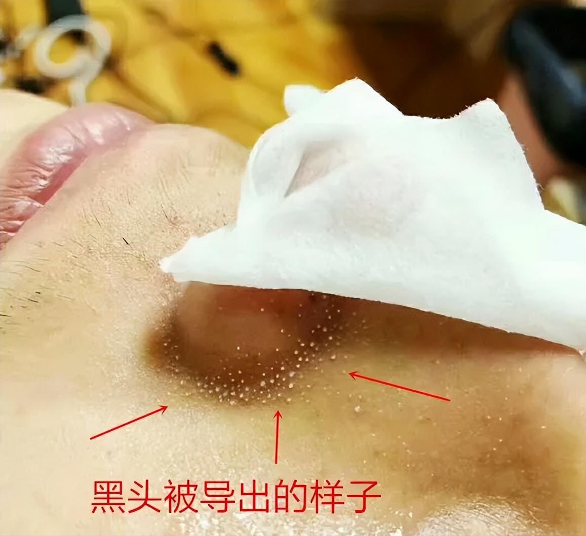 鼻子的黑头跟草莓一样,草莓黑头怎么去除最有效