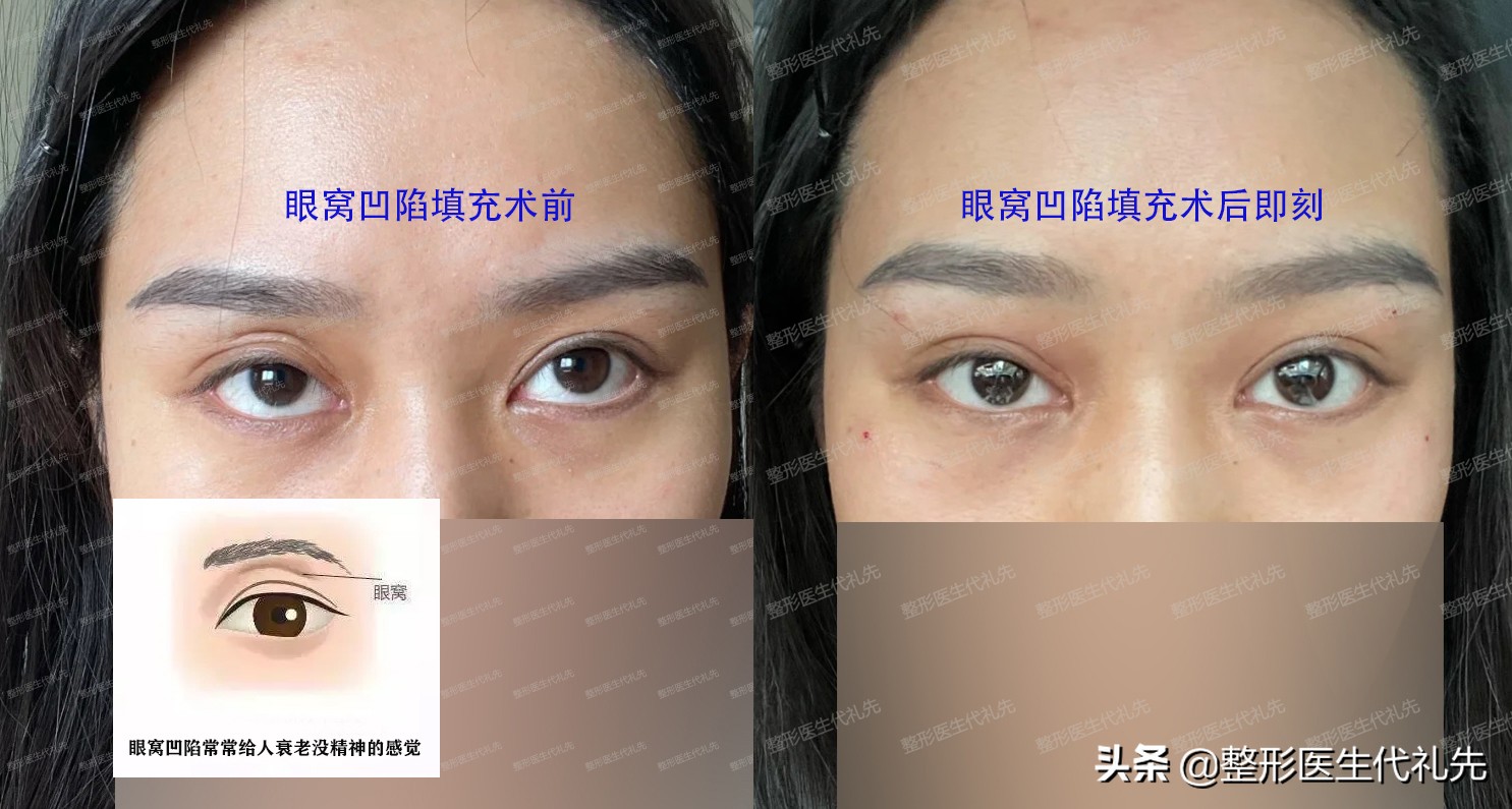 眼窝凹陷眼周脂肪填充眼窝可以吗,眼窝凹陷严重几次眼窝填充好