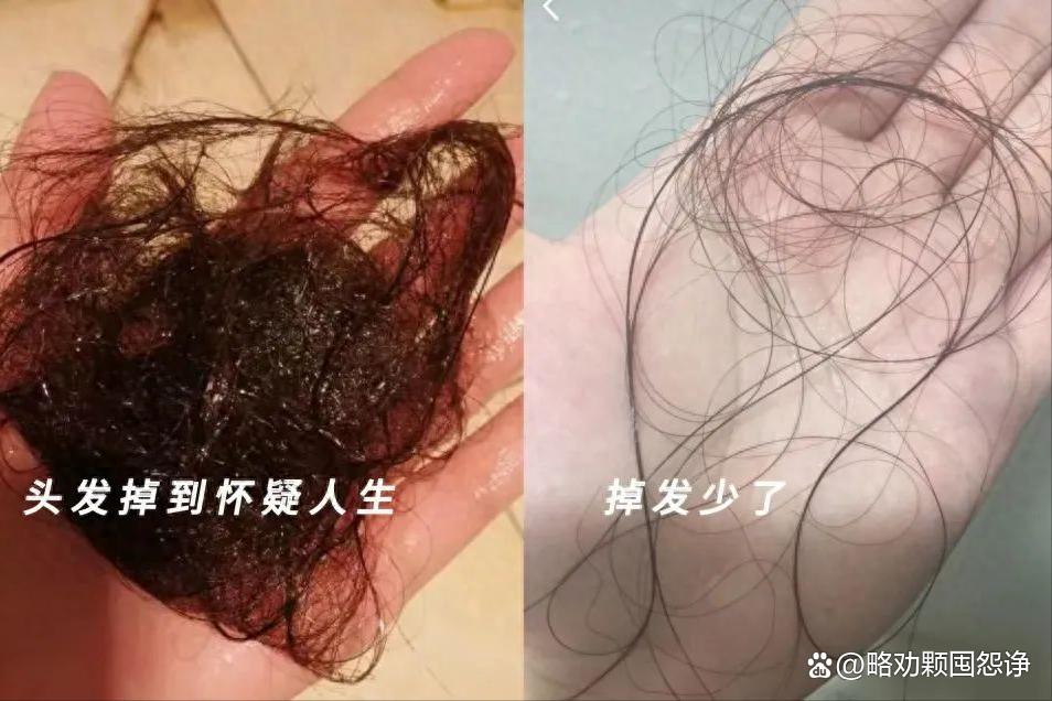 不用花钱就能快速消除头屑,解决脱发不用洗发水