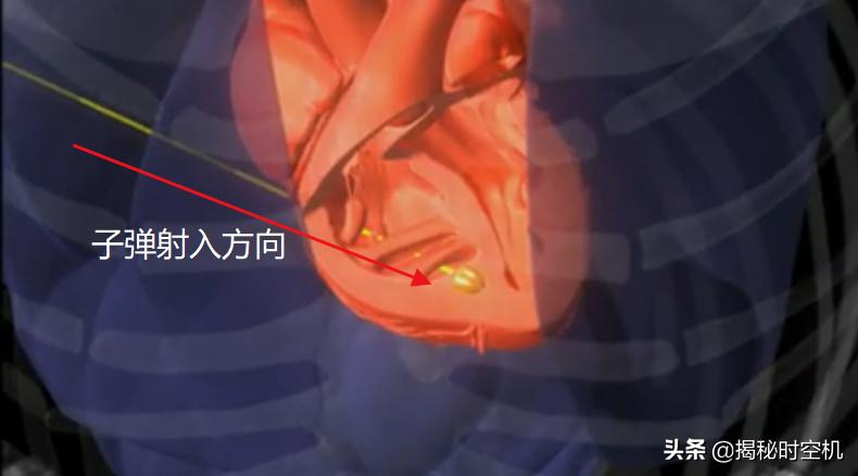 中国孤例！*弹子**击中心脏14年没死？湖南男子奇迹生还至今成谜