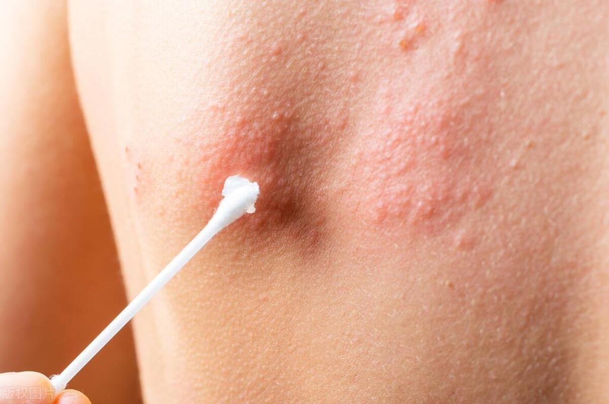 老人有梅毒传染给孩子的例子,八十岁老太查出梅毒用治疗吗