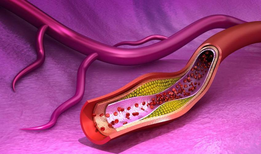 每天吃一个鸡蛋得心梗,每天吃4个鸡蛋得了心脏病案例