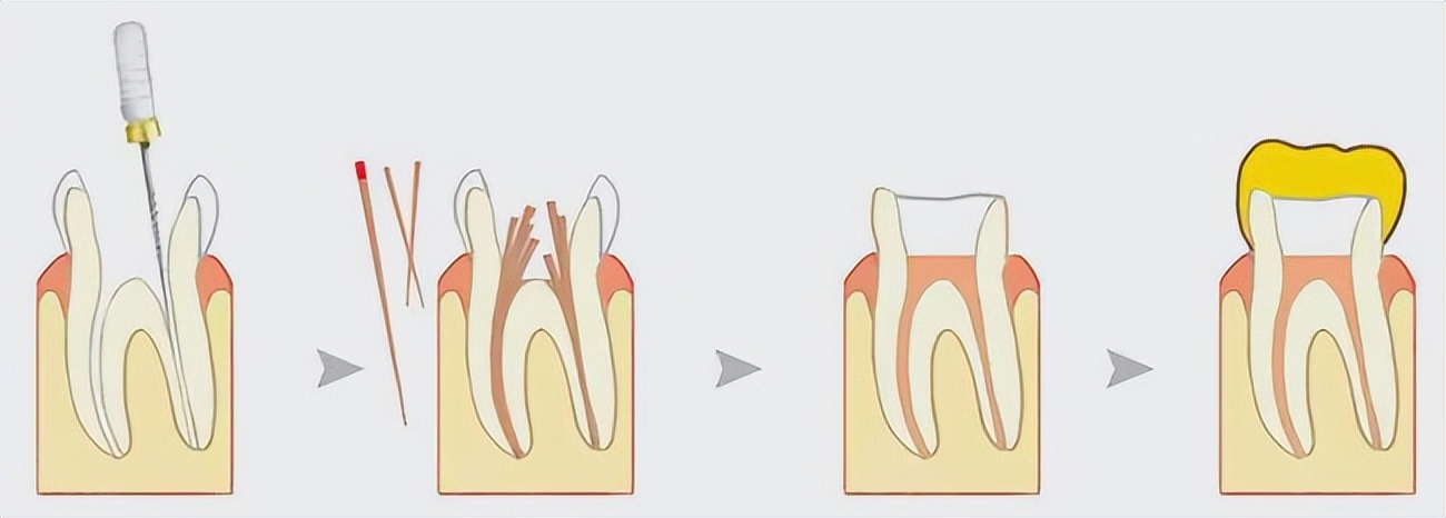 根管治疗后牙齿变黑是什么原因,根管治疗后牙齿寿命