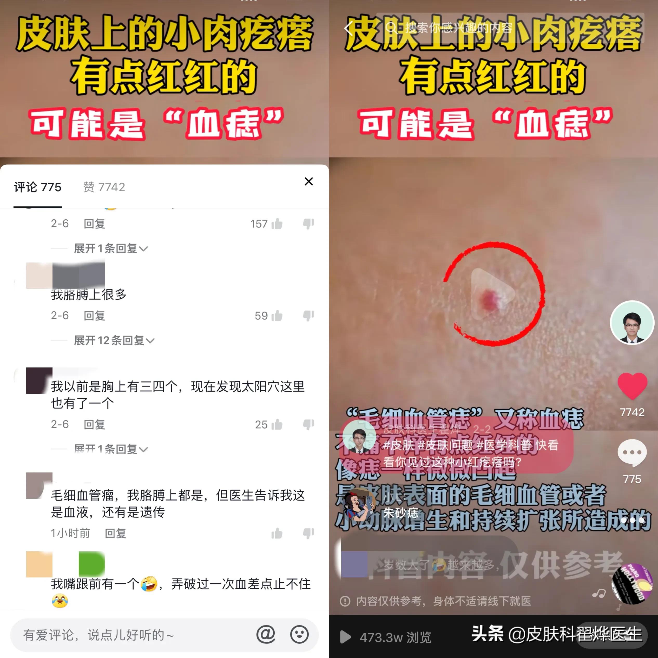 中老年人身上长红痣怎么回事,身上长了好几颗红痣一样的小点