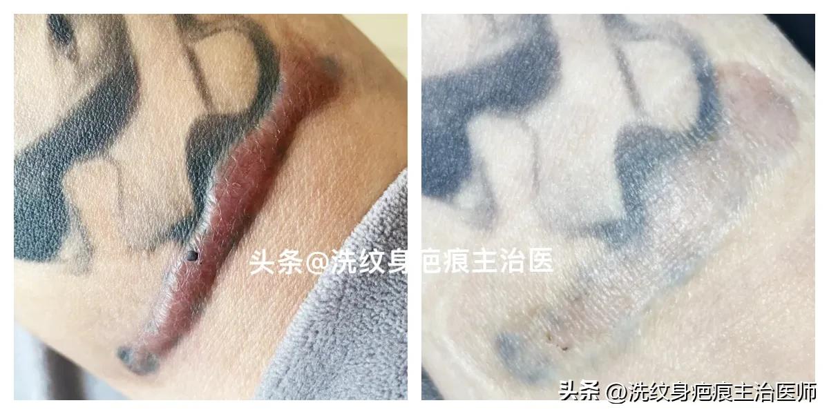 眼袋手术疤痕增生怎么办,剖腹产疤痕增生怎么办