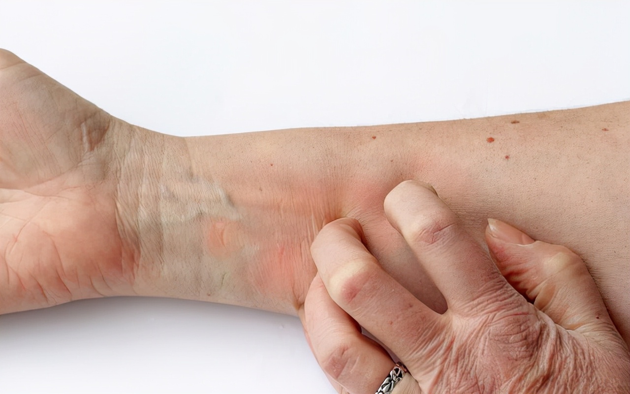 身上起小红点点是不是hpv,身上有红色的小血点是不是hpv