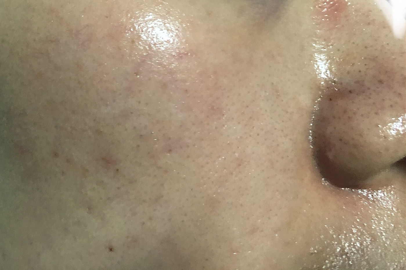 为什么鼻子可以挤出很大的黑头,用夹子挤出鼻子黑头