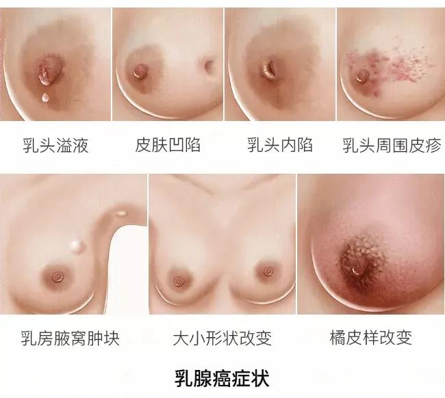 正常人乳房一大一小正常吗,乳房不对称一大一小正常吗