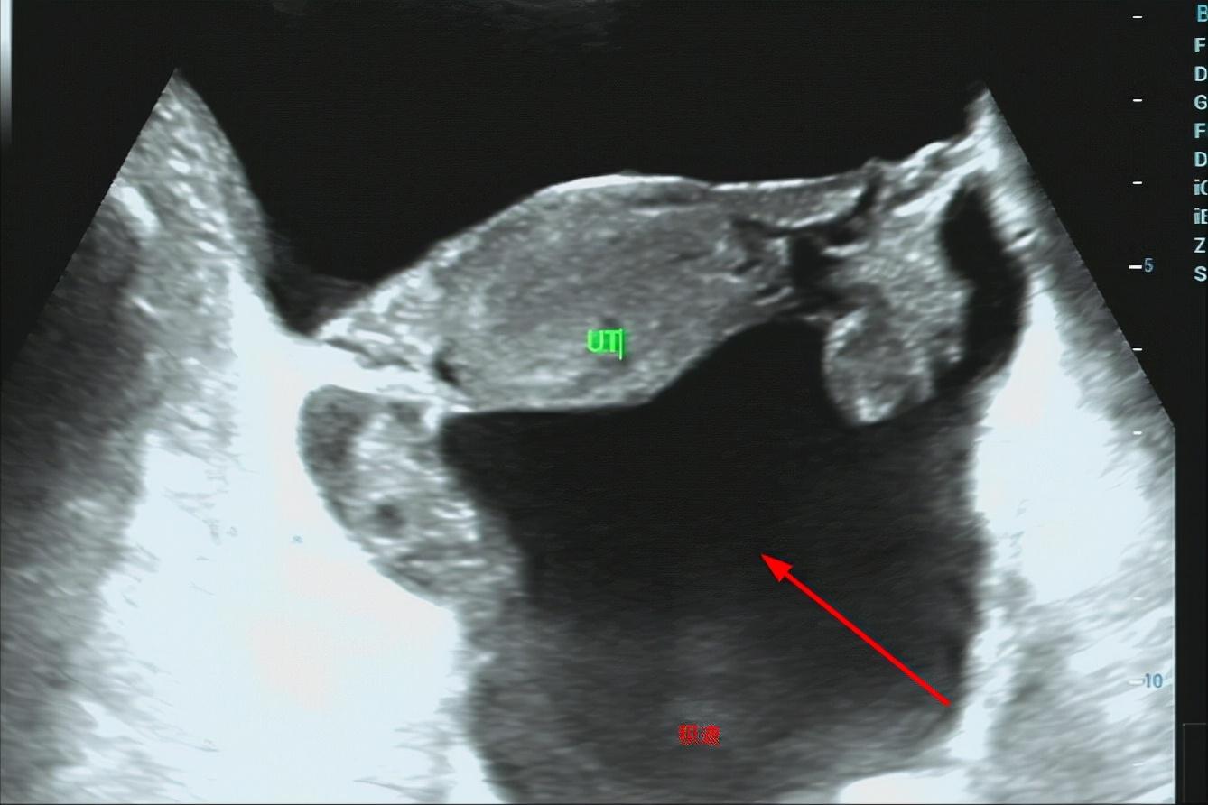 b超能查出盆腔肿瘤吗,B超能查出盆腔炎症吗