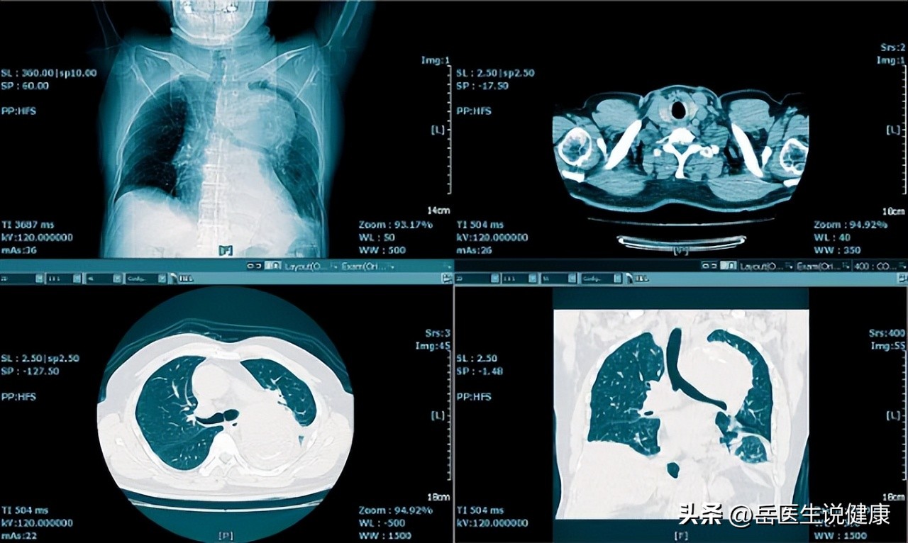肺癌引起肩疼和一般肩疼区别,肩痛可能是肺癌早期