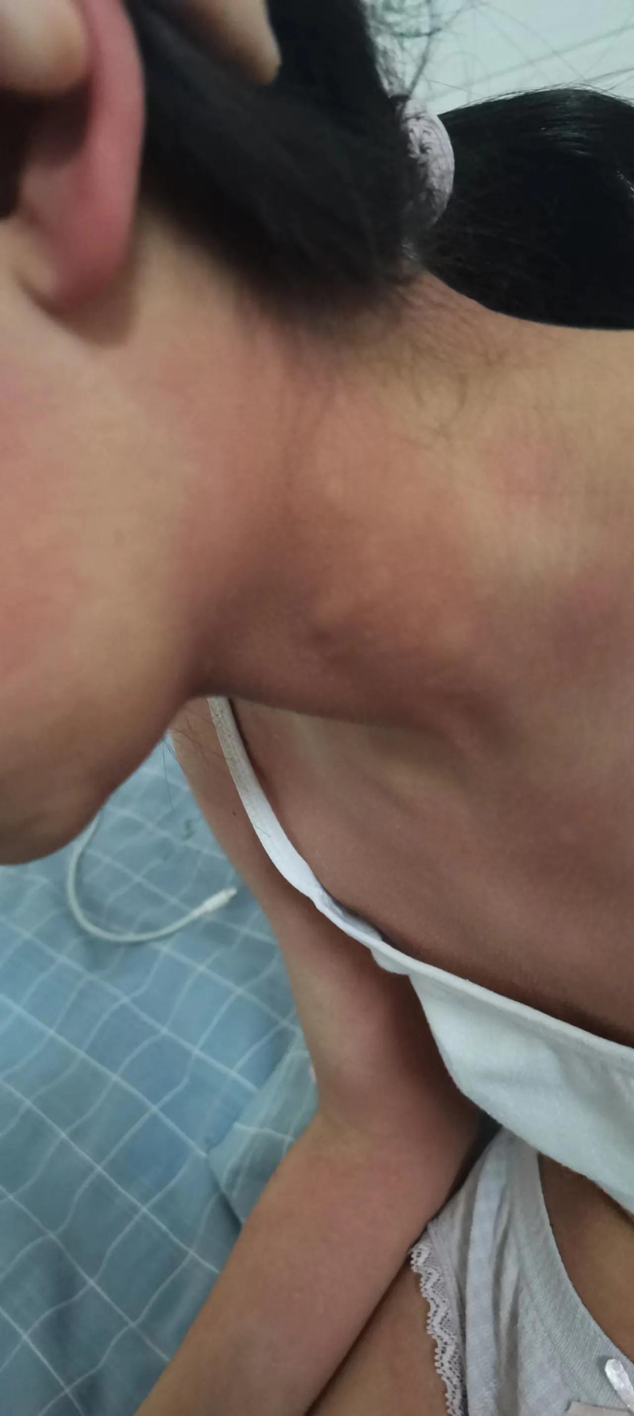 每日一药炉甘石洗剂