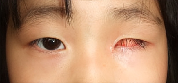 有、无眼球佩戴义眼有什么区别？