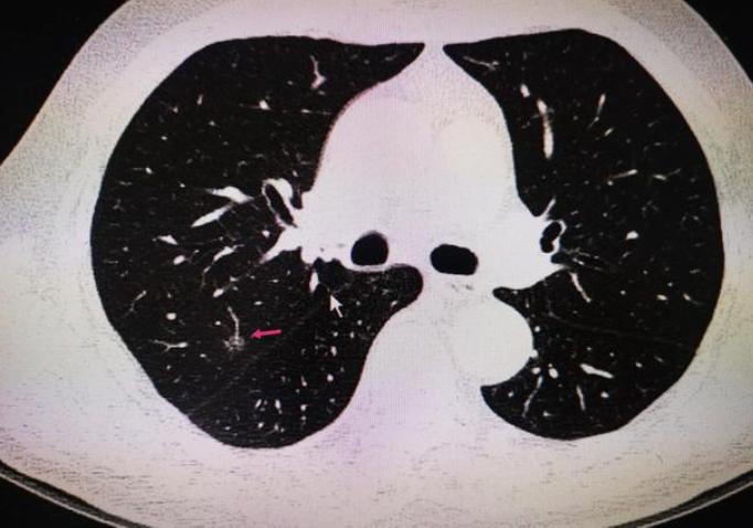 「门诊真实故事」咳嗽、胸闷、疲惫无力，这种肺结节我可以治