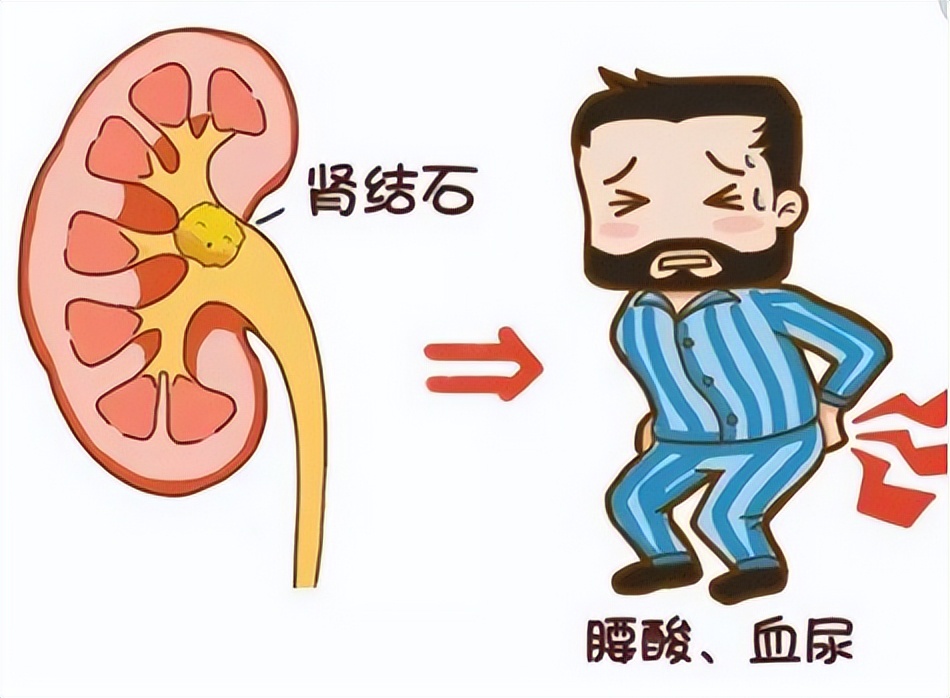 出现肾结石问题一定要明白这几点,关于肾结石你了解多少