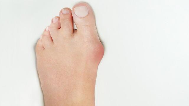 大拇脚趾外翻用什么矫正方法,大脚趾外翻歪怎么办