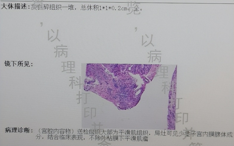 做了子宫内膜息肉会得癌症吗,息肉是肿瘤