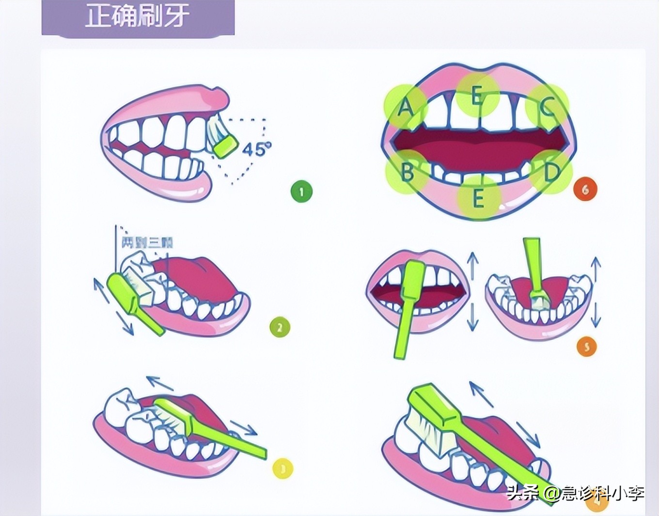 牙缝间的牙结石怎么清除,牙缝里的牙结石怎么去除