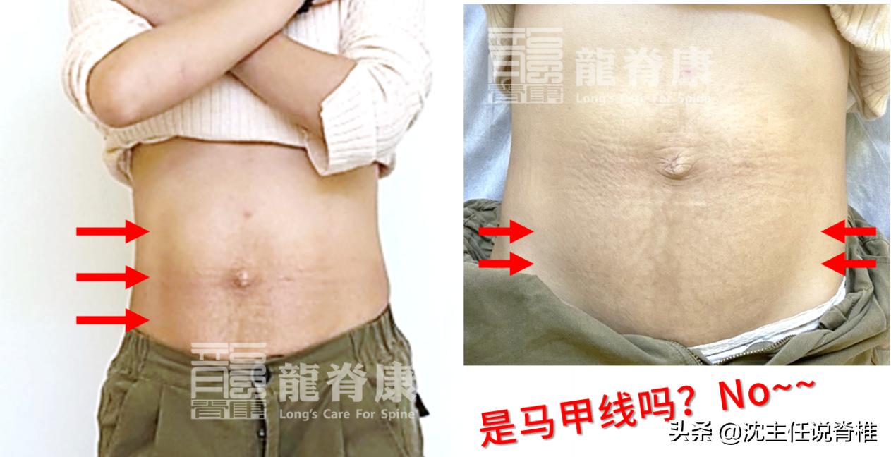 产后内脏下垂小腹突出,产后小腹突出怎么减